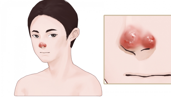 25岁小伙长期挖鼻孔形成血管瘤 经常挖鼻孔的危害有哪些