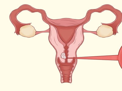 子宫内膜异位症可以做试管吗