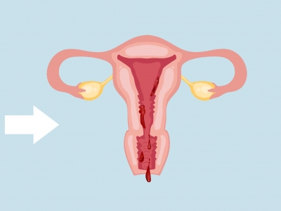 子宫内膜太薄是什么原因造成的