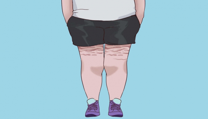 安博体育官网男子因减肥得重度脂肪肝 缘由竟是过分节食(图2)