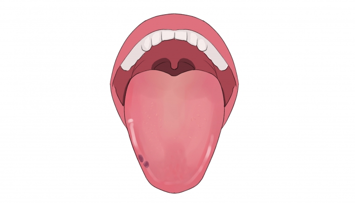 舌头上有裂纹是什么原因 舌头上有裂纹是怎么回事