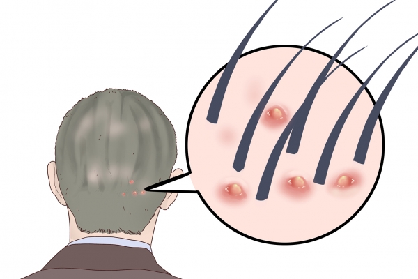 头皮上长痘痘是什么原因
