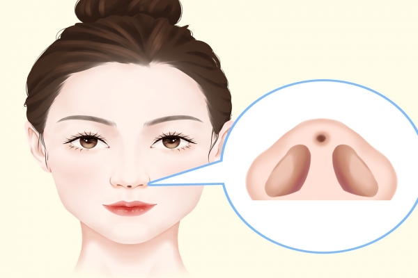 假体隆鼻的后遗症