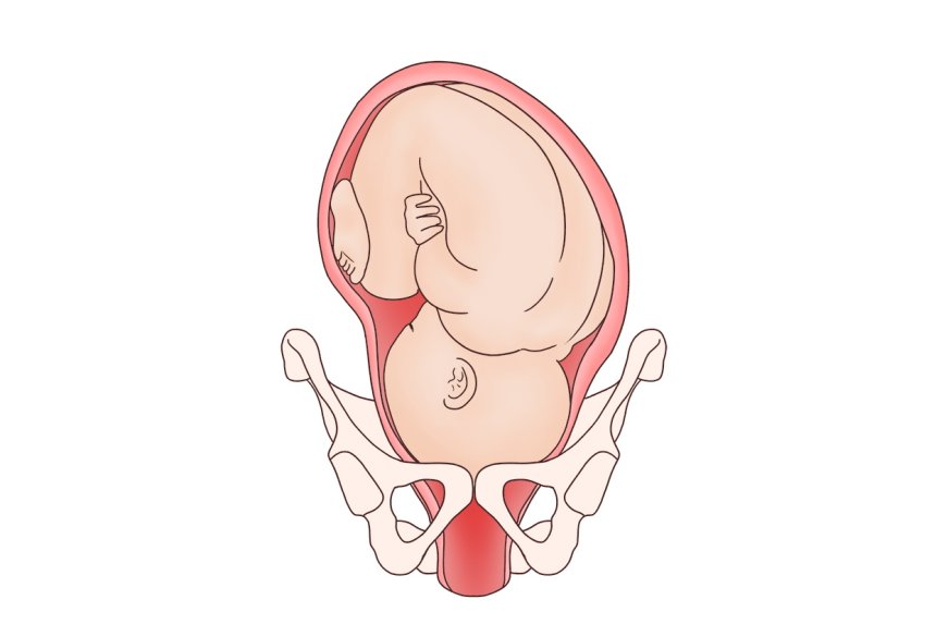 孕晚期头朝下胎心位置图片
